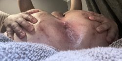 Exposed f*g Hole